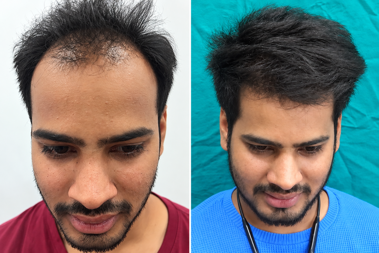 Acne Treatment Before and After